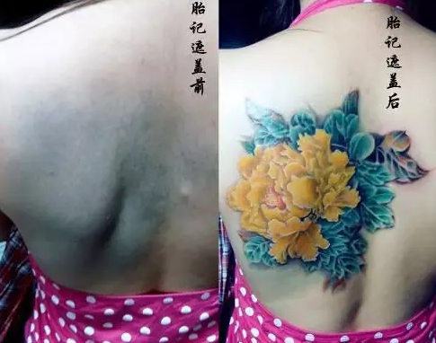 Thời gian vừa qua, xăm hình trở thành trào lưu của giới trẻ, chúng mang mang đến cho người sở hữu cá tính và vẻ quyến rũ. Nhưng ít ai biết rằng, chính những hình xăm còn có một công dụng khác đó là che đi những vết sẹo kém thẩm mỹ.