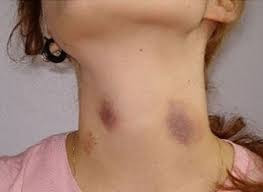 Sau khi tiến hành kiểm tra kỹ hơn, họ đã phát hiện ra nguyên nhân bất ngờ khiến cô gái trẻ tử vong. Các bác sĩ phát hiện trên cổ của Tiểu Nha có một vết hôn rất đậm, để lại dấu bầm rõ ràng trên da. Hóa ra, cô gái đã có bạn trai, và vết bầm đó chính là cách mà anh chàng kia bày tỏ tình yêu sâu đậm của mình.