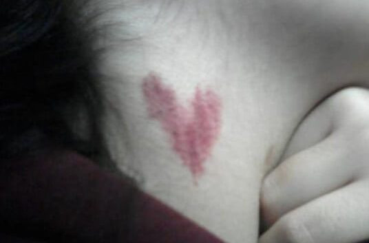 Các bác sĩ đã đưa ra lời giải thích, cho biết khi một vết hôn được tạo ra trên cổ thì sẽ có những cục máu đông được tạo ra. Theo mạch máu, cục máu đông sẽ di chuyển lên não hoặc xuống tim. Nếu cục máu đông đủ lớn sẽ gây ra tình trạng đột quỵ, gây nguy hiểm cho sức khỏe hoặc tính mạng của chúng ta.