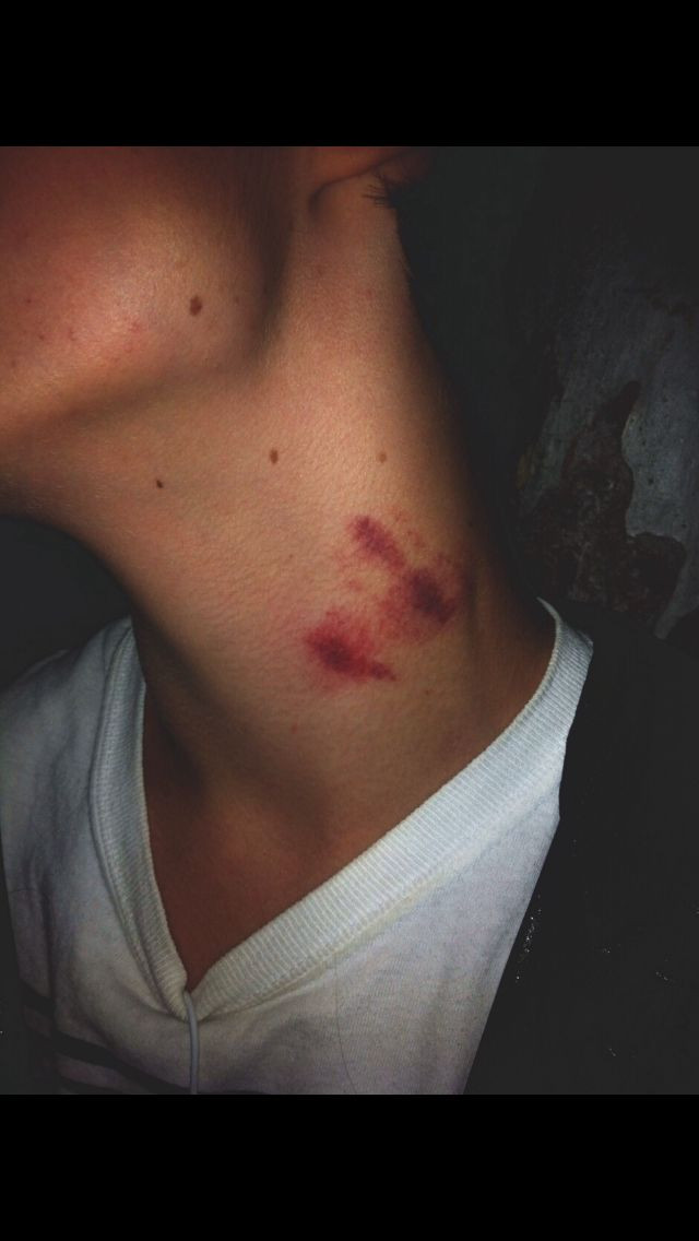 Tuy nhiên, không ai có thể ngờ rằng vết hôn cắn đó lại lấy đi mạng sống của cô gái trẻ mới chỉ 16 tuổi.