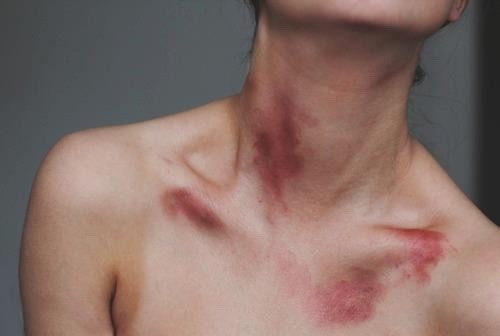 Mới đây, một cô gái tên Tiểu Nha tới từ Trung Quốc đã không may qua đời do vết hôn cắn của người yêu. Theo đó, khi đang ăn tối cùng với gia đình thì cô gái trẻ bất ngờ bị ngã xuống đất và nôn mửa dữ dội.