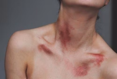 Mới đây, một cô gái tên Tiểu Nha tới từ Trung Quốc đã không may qua đời do vết hôn cắn của người yêu. Theo đó, khi đang ăn tối cùng với gia đình thì cô gái trẻ bất ngờ bị ngã xuống đất và nôn mửa dữ dội.