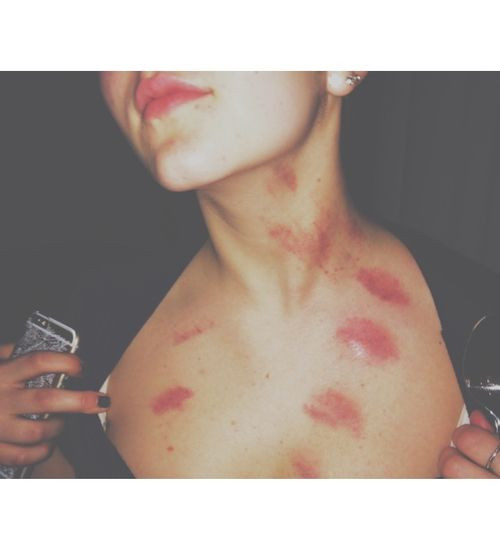 Tuy nhiên, đi kèm với đó là vô vàn những bệnh tật cũng như sự ra đi thương tâm khi lứa tuổi còn rất trẻ của các nạn nhân khi "chơi trò" hickey.