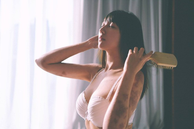 Tháng 11 năm ngoái là khoảng thời gian đầy vất vả và sóng gió của Chichi khi bỗng dưng căn bệnh viêm da cơ địa tái phát. Những mảng da bị viêm sẽ khô lại, đóng vảy và sạm màu hơn hẳn. nữ hoa sĩ này cũng như vậy, ngoại trừ khuôn mặt, gần như toàn thân của cô đều bị bao phủ bởi những vết sẹo lồi xù xì.