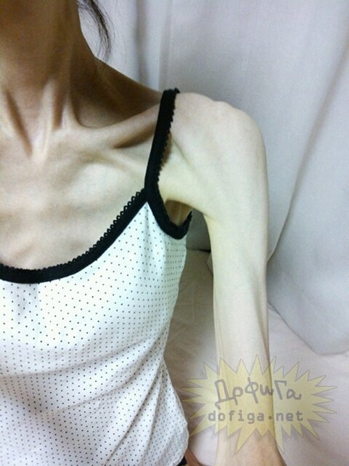 Hình ảnh về cô gái siêu gầy giấu tên này đã được tung lên một số trang mạng, cho thấy rõ độ gầy của cô gái như thế nào. Cô gái được cho có độ tuổi khoảng hơn 20 và có chiều cao 1,68 m. Ở độ tuổi xuân thì, lẽ ra trông cô gái phải thật căng tràn sức sống, đầy đặn. Tuy nhiên, một bức ảnh chụp hình chiếc cân đã tiết lộ số cân nặng của cô chỉ dừng lại ở mức 26,9kg.