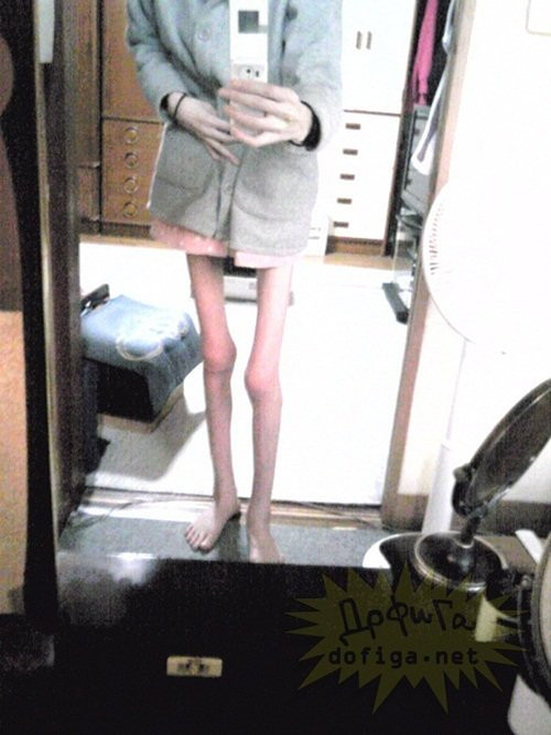 Chính bởi có cân nặng quá nhẹ như vậy nên thân hình của cô cũng lộ rõ sự gầy gò. Từ trên xuống dưới, mọi bộ phận của cô đều gầy trơ xương. Hai bàn chân như hai que tăm, cánh tay cũng khẳng khiu, nổi gân guốc đáng sợ. Thậm chí khuôn mặt của cô cũng chẳng mấy đẫy đà.