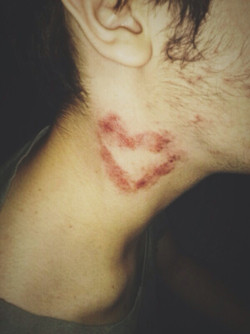 Tuy nhiên, hickey thực sự rất nguy hiểm. Nếu không cẩn thận, những vết cắn, vết hôn mạnh sẽ khiến cho sự vận chuyển máu bị tắc nghẽn, hình thành tắc động mạch, tạo máu đông, cuối cùng gây nên hiện tượng đột quỵ.