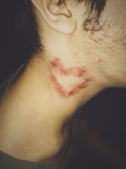 Tuy nhiên, hickey thực sự rất nguy hiểm. Nếu không cẩn thận, những vết cắn, vết hôn mạnh sẽ khiến cho sự vận chuyển máu bị tắc nghẽn, hình thành tắc động mạch, tạo máu đông, cuối cùng gây nên hiện tượng đột quỵ.