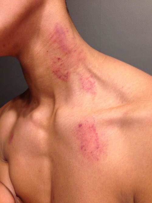 Trên MXH, rất nhiều bạn trẻ đã khoe "chiến tích" đánh dấu chủ quyền sau khi thực hiện nụ hôn "Hickey Kiss" với người yêu.