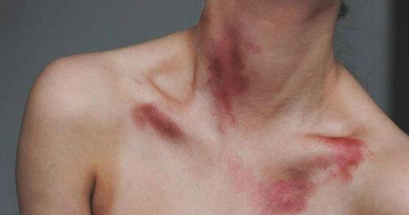 Dù được cảnh báo rất nhiều nhưng nhiều cặp đôi vẫn liều lĩnh, thử cảm giác mạnh của nụ hôn tử thần mang tên Hickey Kiss.