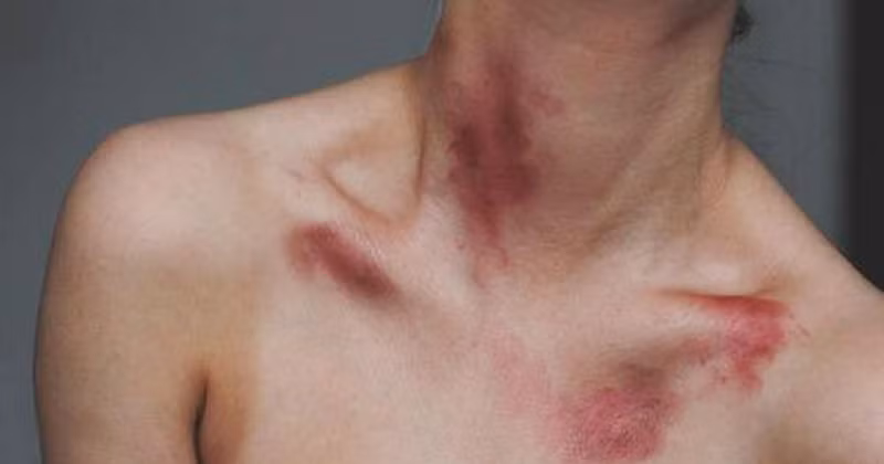 Dù được cảnh báo rất nhiều nhưng nhiều cặp đôi vẫn liều lĩnh, thử cảm giác mạnh của nụ hôn tử thần mang tên Hickey Kiss.