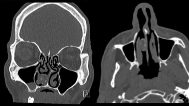 Tu nhan nhet can sa vao mui de buon lau va ket dau don