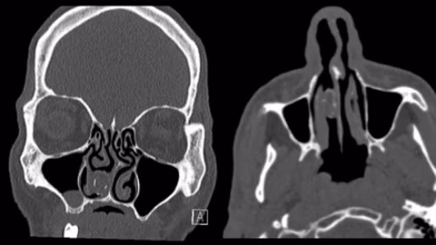Tu nhan nhet can sa vao mui de buon lau va ket dau don