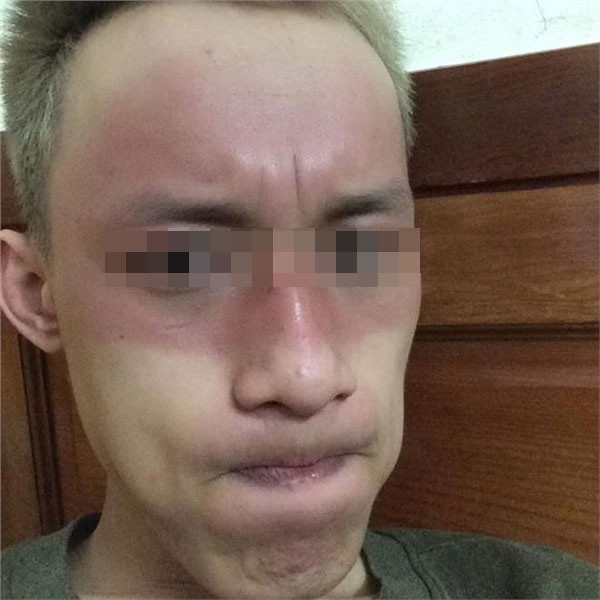 Khuôn mặt 2 màu da, thật đáng sợ của chàng trai dù đã cố che chắn nhưng không "xi nhê" với cái nắng đến rát mặt.