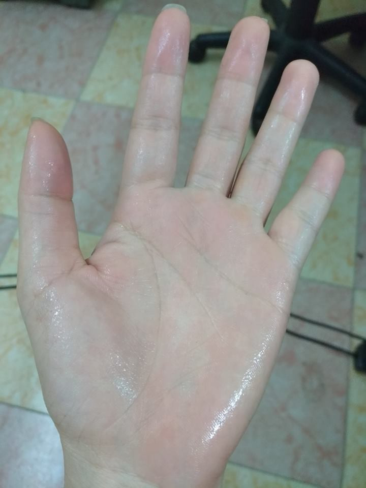 Mới đây trên mạng xã hội, dân mạng đã cho đăng tải album tổng hợp những bức ảnh về đôi bàn tay ướt sũng vì nỗi khổ đổ mồ hôi tay. Rất nhiều bạn trẻ đã kể hoàn cảnh của mình khi mắc phải chứng bệnh này.