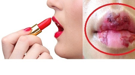 Lại có một trường hợp khác cô gái có làn da ngăm nhưng khỏe khoắn, mịn màng. Vì muốn có màu da trắng nên cô bất chấp dùng kem trộn theo lời mời chào trên mạng xã hội. Ảnh trong bài: Sưu tầm Facebook.