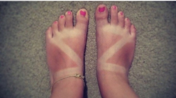 Hậu quả của việc đi dép xăng đan rồi bêu nắng ngoài đường.