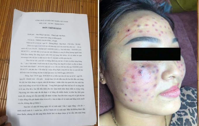 Them khach hang bi lech mat sau khi lam dep o spa 