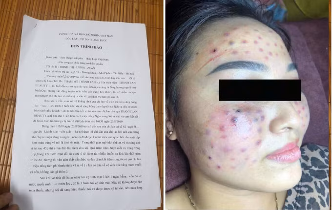 Them khach hang bi lech mat sau khi lam dep o spa 