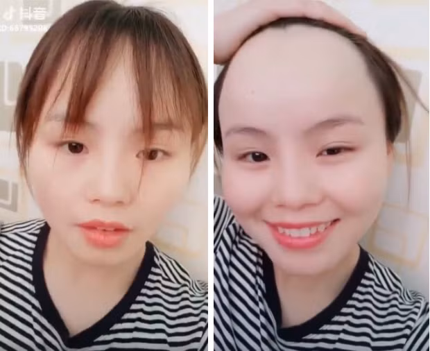 Con gái là đối tượng bị ám ảnh bởi vẻ đẹp ngoại hình đặc biệt là khuôn mặt. Sau trào lưu khoe má tròn phúng phính, tiếp đây các chị em còn chẳng ngần ngại vén lớp tóc mái khoe vầng trán sân bay vô cùng hài hước.