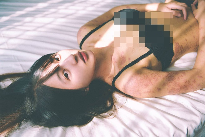 Chichi là nữ họa sĩ xinh đẹp luôn lạc quan và rạng rỡ lại mắc phải căn bệnh viêm da cơ địa (hay còn gọi là chàm thể tạng hoặc viêm da atôpi - AD). Đây là căn bệnh khiến làn da bị những vệt tụ máu lớn trên cơ thể khiến ai mắc phải cũng phải tự ti vì bản thân.