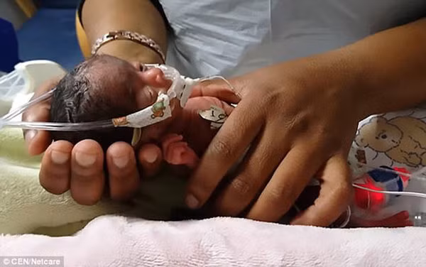 Sinh non nho bang 1/10 tre so sinh binh thuong, be gai ti hon gay choang vang-Hinh-2