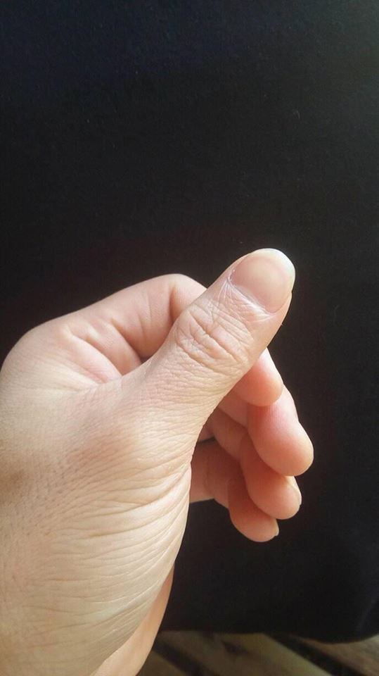 Nhiều bạn trẻ có ngón tay bình thường thì cho rằng, trào lưu khoe ngón tay cái dị này khá hay bởi họ cho rằng: ""Hình hài của mẹ cha cho", thế nên thay vì kêu ca phàn nàn thì hãy lấy đó làm niềm vui vì chẳng ai giống mình cả".