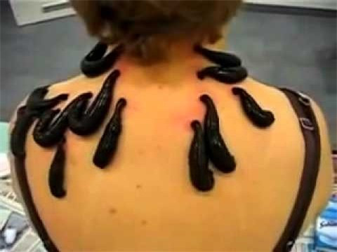 Chữa bệnh bằng cách cho đỉa bám lên người: Trong Đông y, đỉa từ lâu đã được xem là một phương thuốc quý và được xử dụng để chữa các bệnh như thừa dịch hay máu độc… Người ta tin rằng khi đỉa hút đi phần máu độc sẽ làm cho máu lưu thông dễ dàng và vết thương cũng mau lành hơn. Không chỉ vậy, cách chữa trị này còn được cho là có lợi cho các bệnh về xương khớp hay cho các phẫu thuật chỉnh hình. Mặc dù có hiệu quả, xong cách chữa bệnh siêu quái dị này không hề đơn giản, thậm chí có thể dẫn đến nguy hiểm nếu không có chỉ định của bác sĩ.