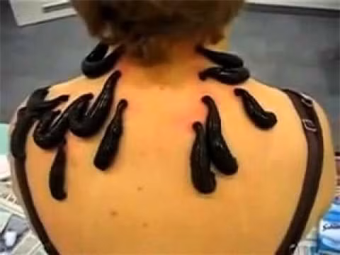 Chữa bệnh bằng cách cho đỉa bám lên người: Trong Đông y, đỉa từ lâu đã được xem là một phương thuốc quý và được xử dụng để chữa các bệnh như thừa dịch hay máu độc… Người ta tin rằng khi đỉa hút đi phần máu độc sẽ làm cho máu lưu thông dễ dàng và vết thương cũng mau lành hơn. Không chỉ vậy, cách chữa trị này còn được cho là có lợi cho các bệnh về xương khớp hay cho các phẫu thuật chỉnh hình. Mặc dù có hiệu quả, xong cách chữa bệnh siêu quái dị này không hề đơn giản, thậm chí có thể dẫn đến nguy hiểm nếu không có chỉ định của bác sĩ.