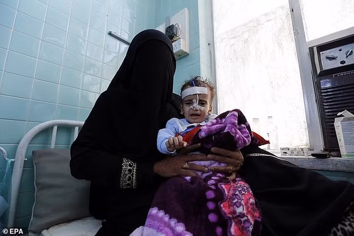 Một người mẹ đang ôm đứa con bị suy dinh dưỡng nghiêm trọng tại trung tâm điều trị suy dinh dưỡng ở Sana'a, Yemen.