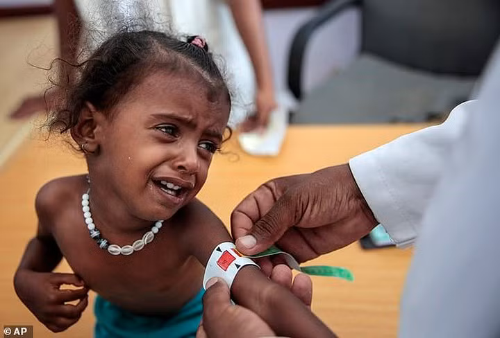 Khoảng 1,8 triệu trẻ em dưới 5 tuổi bị suy dinh dưỡng cấp và 400.000 trẻ bị suy dinh dưỡng nặng. Ảnh: AP.