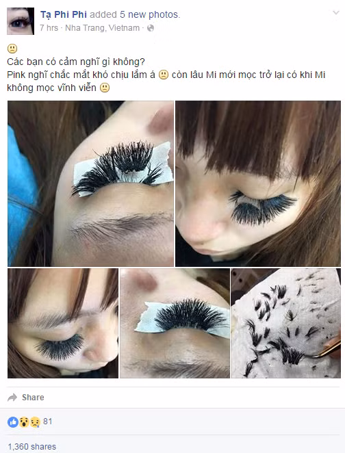 Trước đó, một cô gái bị trụi hết lông mi do việc nối mi quá dày, những hình ảnh này được chia sẻ lần đầu tiên từ Facebook của một cơ sở nối mi tại Nha Trang.