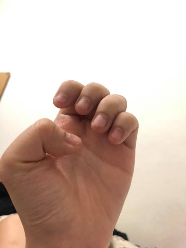 Không chỉ có H.H là nạn nhân của mỏng tay xấu mà đó còn là nỗi khổ của biết bao chị em khi móng mọc lởm chởm và không thể chữa được bằng cách làm nail.