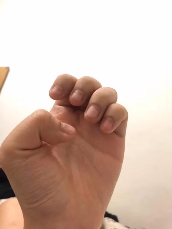 Không chỉ có H.H là nạn nhân của mỏng tay xấu mà đó còn là nỗi khổ của biết bao chị em khi móng mọc lởm chởm và không thể chữa được bằng cách làm nail.