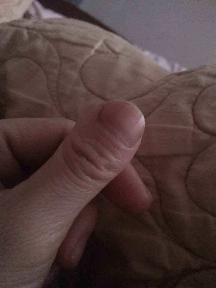 Cả bàn tay đẹp trừ ngón cái.