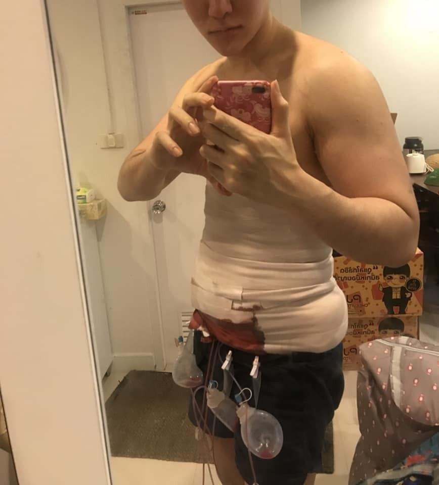 Để thực hiện được cách phẫu thuật body 6 múi này, bác sĩ sẽ tiến hành hút mỡ bụng bệnh nhân để các múi cơ lộ ra. Sau đó, họ tiếp tục được tách tế bào mỡ từ các rãnh giữa khối cơ, kết hợp tia laser để cầm máu bệnh nhân. Quá trình tạc cơ bụng này kéo dài từ 1-2 giờ đồng hồ.