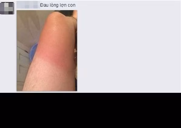 Hậu quả của việc mặc quần ngắn ra đường những ngày nắng nóng đỉnh điểm.