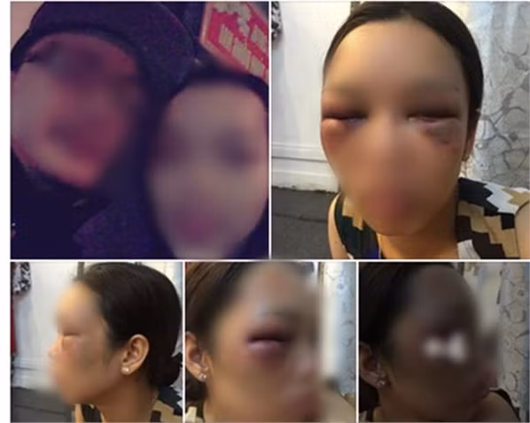 Co dau bi danh bam tim mat vi tu choi hon chong trong dam cuoi