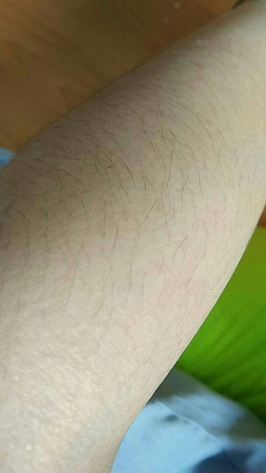 Cũng vì thế mà nhiều chị em chẳng dám diện quần short, cũng "bái bai" luôn đống váy vóc điệu đà.