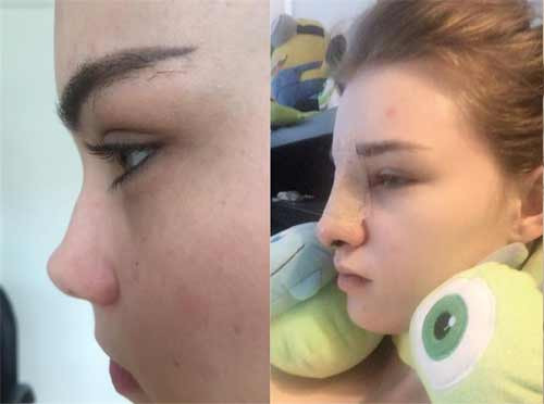 Theo những bức ảnh mới đây xuất hiện trên mạng xã hội, sống mũi của cô nàng này không cao, đầu chóp mũi to, làn da hơi xỉn màu...