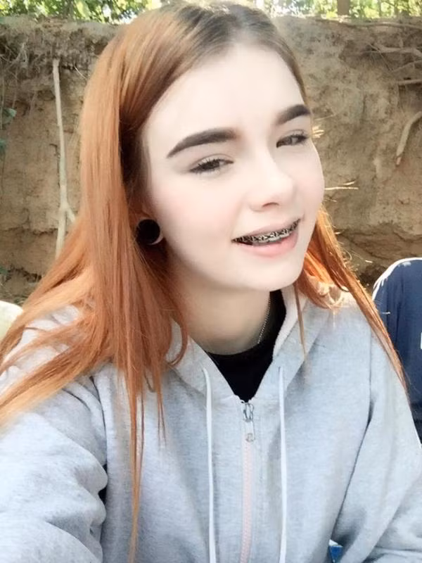 Bức ảnh niềng răng của Jessie Vard.