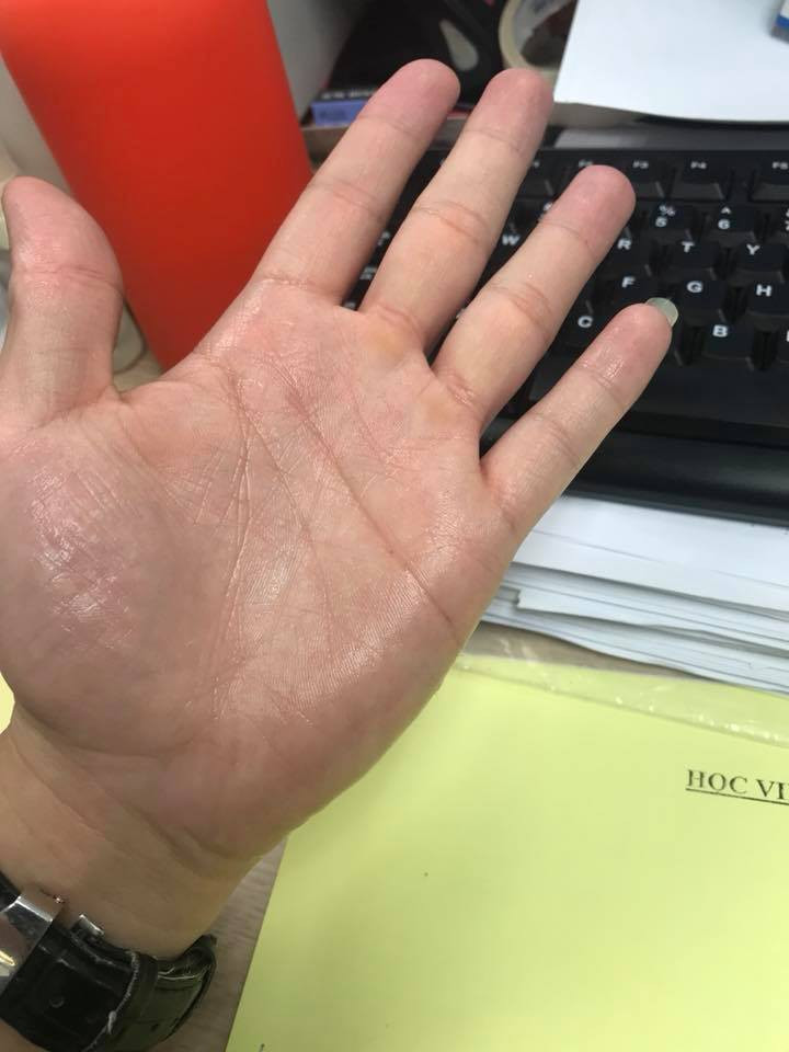 Dù không nguy hiểm đến tính mạng nhưng việc đổ mồ hôi tay khiến người bệnh dễ bị mất nước, mất muối và nhanh mệt mỏi.