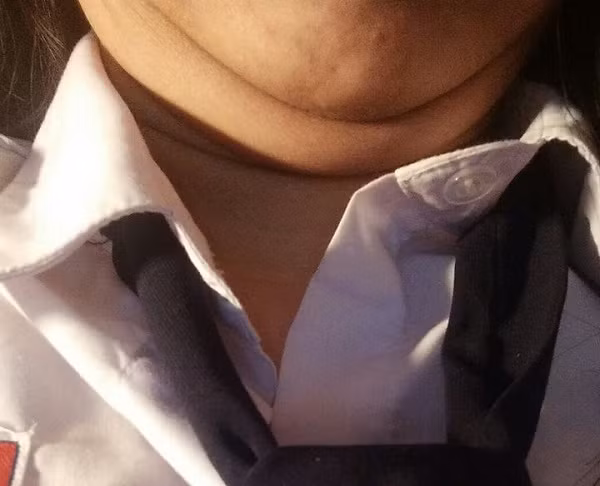 Bên cạnh đó, vẫn có những chị em không vui việc khuôn mặt hai cằm của mình. Đơn cử như bạn trẻ Minh Hoa: "Nhìn chỉ cười nhẹ một tí, sao lại ra nông nỗi cơ chứ. Em buồn lắm nhưng chẳng biết sao được?"