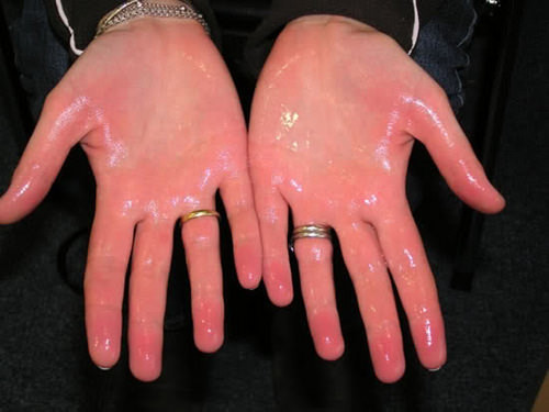 Những người bị đổ mồ hôi tay làm gì cũng mang tính thử thách hơn bình thường...