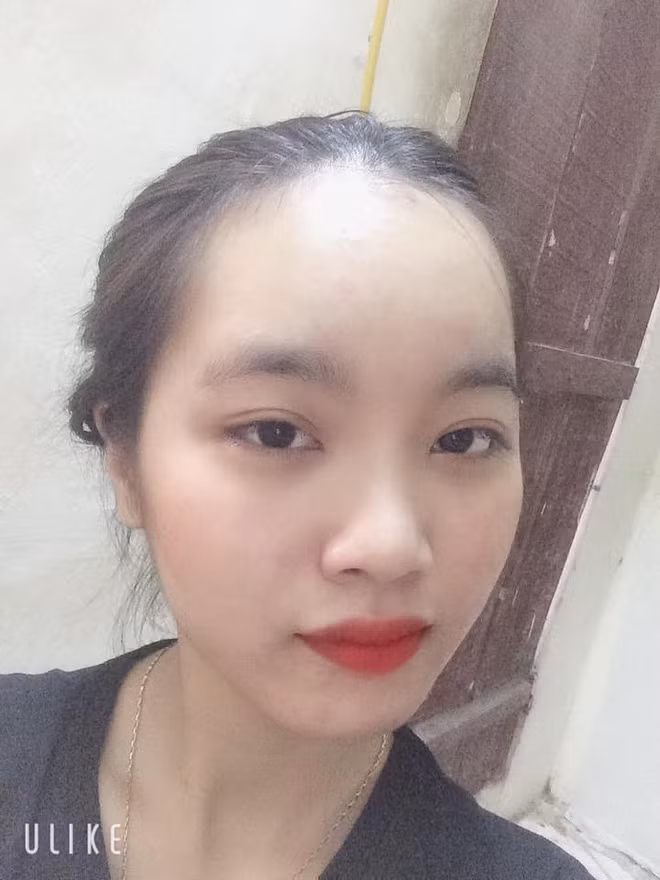 Trán lúc nào cũng đi trước người là đây chứ đâu, nhìn cái trán chiếm hết nửa khuôn mặt có buồn không cơ chứ.