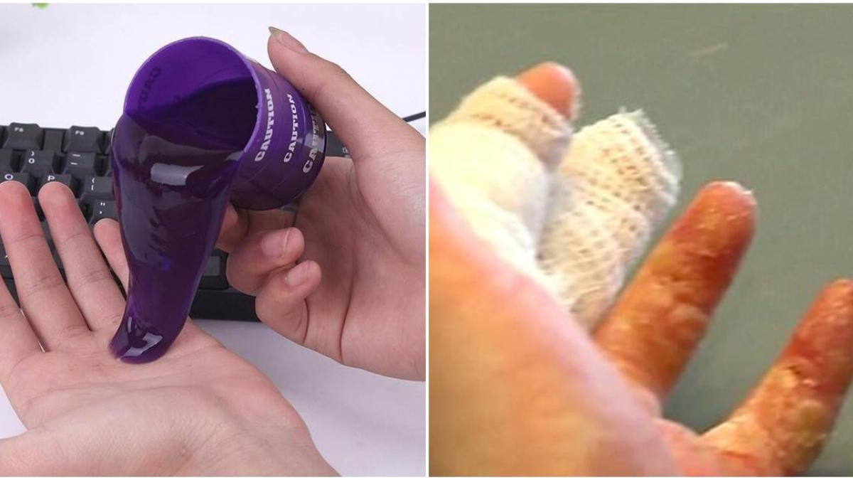 Mới đây trên MXH, một số trường hợp về tác hại của chất nhờn ma quái đã được dân mạng biết đến và nó chủ yếu liên quan đến các bệnh về da như viêm da mủ, ngộ độc, thậm chí vô sinh…