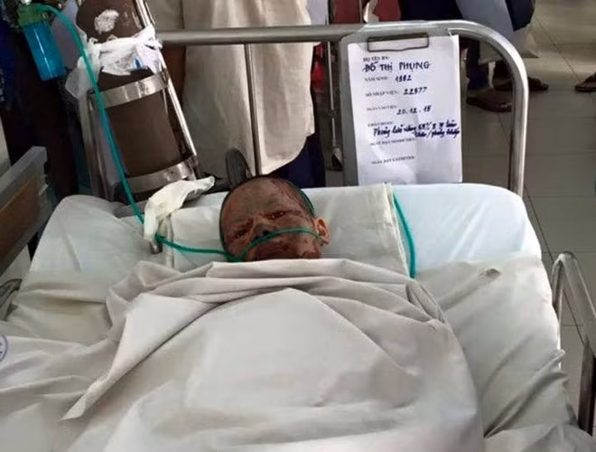 Thuong xot co gai bi ban trai thieu song da qua doi