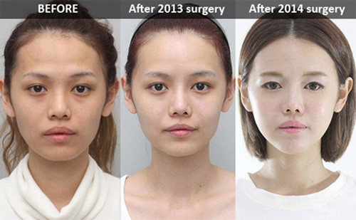 Sau khi thực hiện ca phẫu thuật thẩm mỹ, khuôn mặt của Qiu Qiu trở nên gọn gàng hơn và da dẻ có phần trắng sáng hơn thời gian trước.