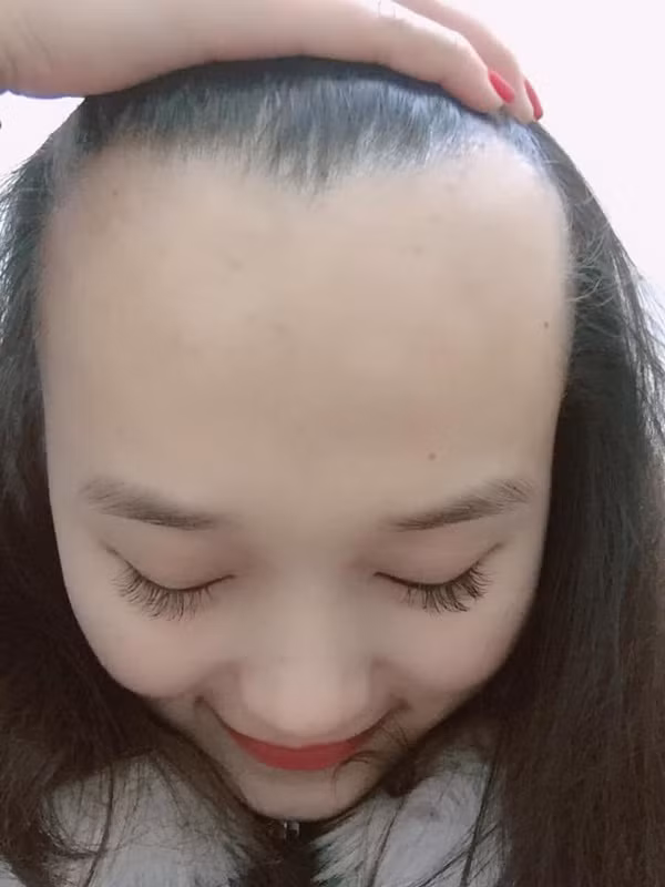 Mà chẳng phải riêng cô nàng này, nhiều chị em cũng tỏ ra mệt mỏi khi thường xuyên phải để tóc mái, kể cả là trong mùa hè nóng bức cũng chỉ nhằm mục đích che giấu chiếc trán dô bất đắc dĩ mà thôi.