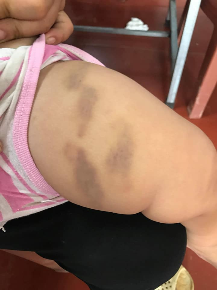 Đứng trên phương diện là một giáo viên đang dạy mầm non, nickname Thanh Thúy chia sẻ: "Mẹ gì kì vậy? thấy con bị đánh còn giấu nhà chồng, giấu chồng, nhận được vài triệu với hộp sữa cho con chắc nghĩ to nên định để im cho xuôi chuyện. Xin lỗi chứ cái dấu răng kia thì không thể nào là của trẻ con được, và nếu có là trẻ con thì cô ở đâu khi cháu bé bị cắn? Khốn nạn cả giáo viên lẫn con mẹ".